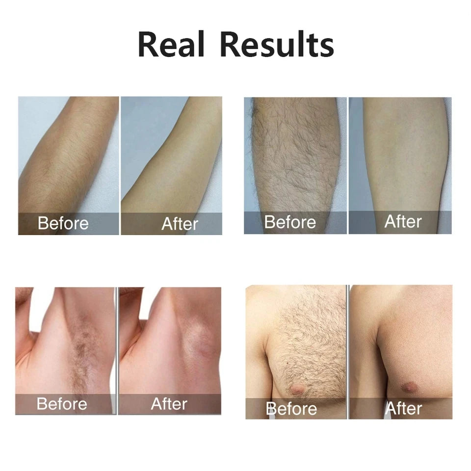 Professional IPL Laser Hair Remover 990000 Flashes for Women & Men - Painless, Permanent Hair Removal for All Body Areas