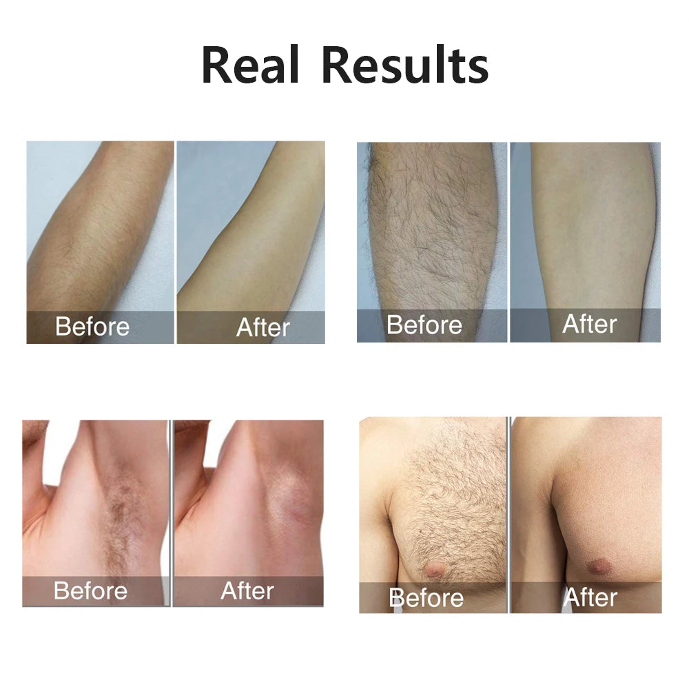 Professional IPL Laser Hair Remover 990000 Flashes for Women & Men - Painless, Permanent Hair Removal for All Body Areas